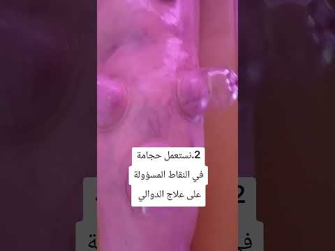 مشكل الدوالي  