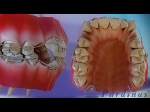 کشیدن دندان برای ارتودنسی کلینیک دندانپزشکی سیمادنت