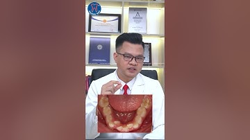 Có nên nhổ răng mọc lẫy?  #bsngotungphuong