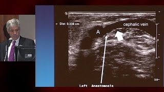 The Gig Is Up! Abandon This Access - UCSF Vascular Symposium 2016