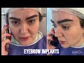 Thin Brows to Perfect Brows | Eyebrow Transplant Journey