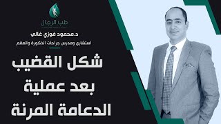 شكل القضيب بعد عملية الدعامة المرنة/ دكتور محمود فوزي غالي