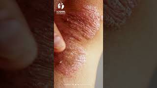 Psoriasis Comprendre Cette Maladie Méconnue Et Agir Efficacement