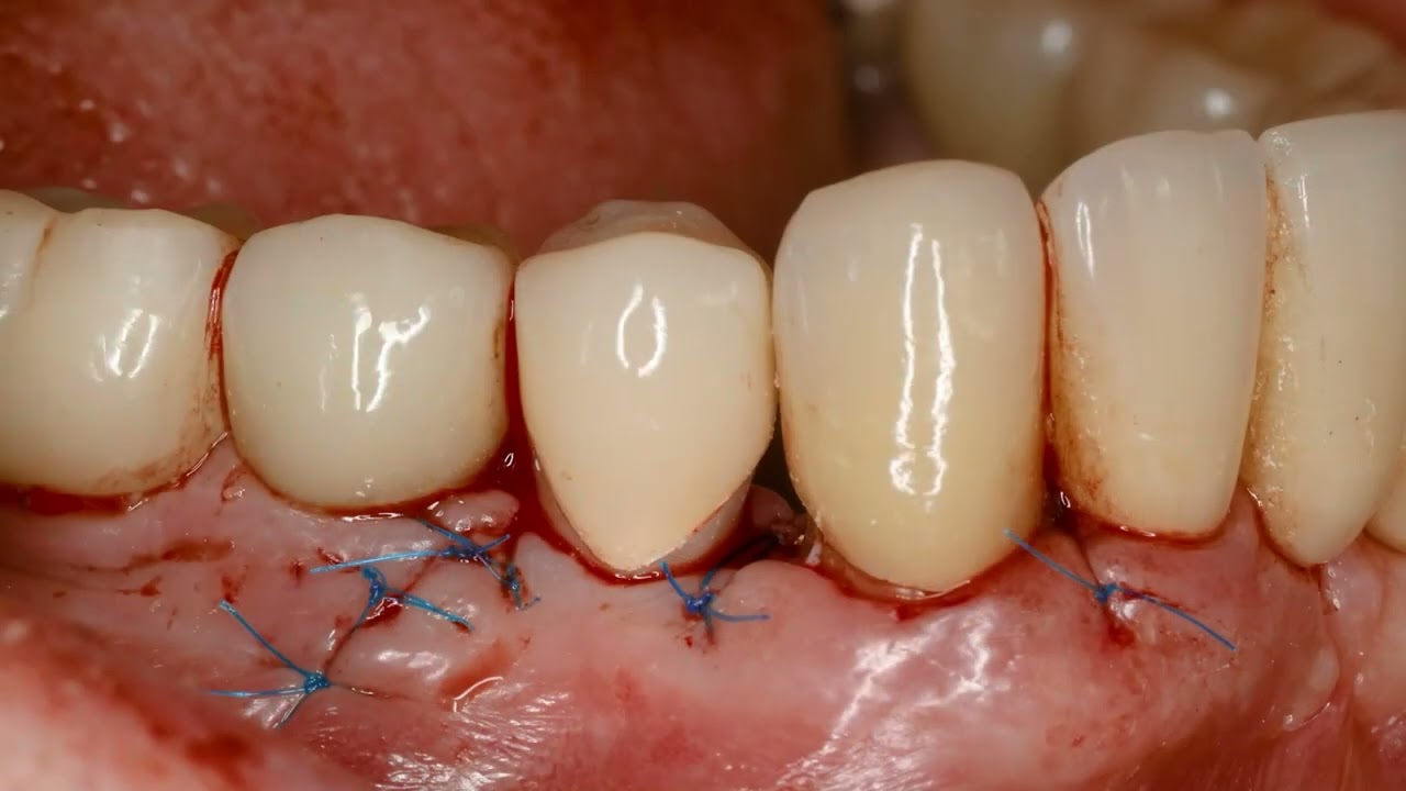 2023 3. Videopreis: "Das SafetyCrown-Konzept"