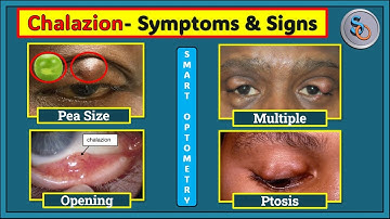 Chalazion- Clinical Features or Symptoms/Signs of Chalazion