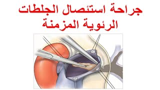 جراحة استئصال الجلطات الرئوية المزمنة - علاج جلطة الرئة المزمنة - pulmonary endartrectomy