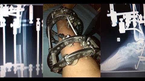 ILIZAROV PROCEDURE/FIXATOR