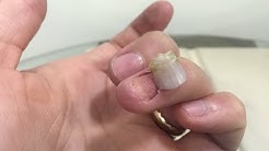 Removing my fingernail / Amputating my fingernail / ripping off my fingernail!
