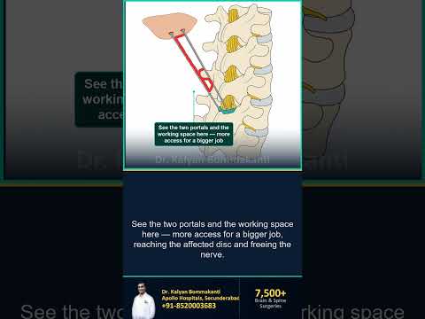 Monoportal or Biportal: How I Choose - Best Monoportal Endoscopic Spine Surgeon, Hyderabad