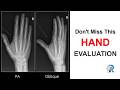 Hand X-ray Interpretation: Step-by-Step OSCE Guide | Hand X-ray Series Part 3