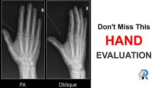 Hand X-ray Interpretation: Step-by-Step OSCE Guide | Hand X-ray Series Part 3
