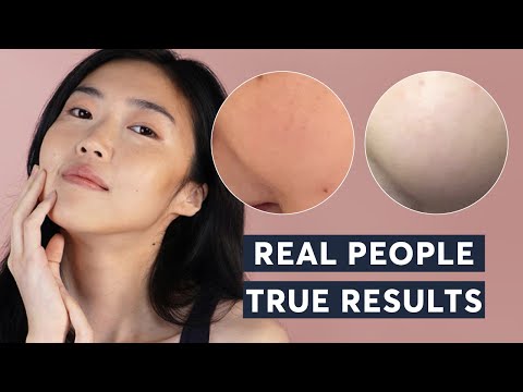 Skin Pigmentation Treatment | Real People, True Results 2023