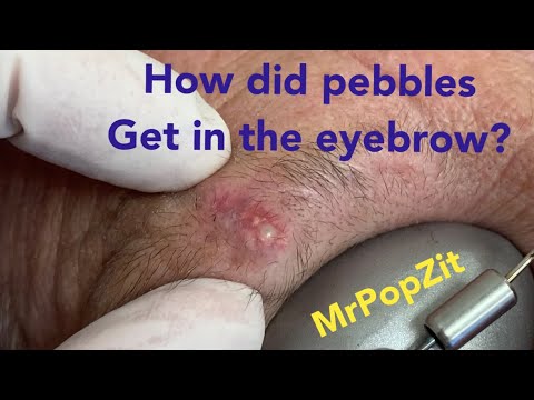 Pocket full of Pebbles cyst One of a kind pebble pop Youve never seen a pebble cyst pop before