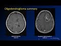 Imaging brain tumors  3  oligodendrogliomas