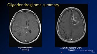 Imaging brain tumors - 3 - Oligodendrogliomas