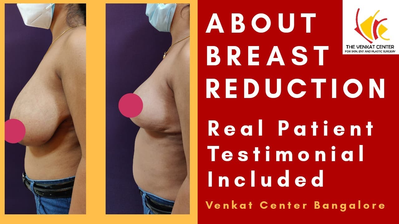 Breast Reduction Surgery in Ahmedabad India ADORN