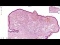 Capillary hemangioma  skin histopathology