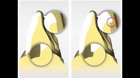 【Six-Minute Saturday】Clinical Decisions and Chairside CADCAM workflows for Veneers - By 艾瑞瓷講師 Dr. 陳鉉