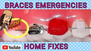 Braces Emergencies! - Fixes! How To Fix Broken Braces at Home if Orthodontist is Closed