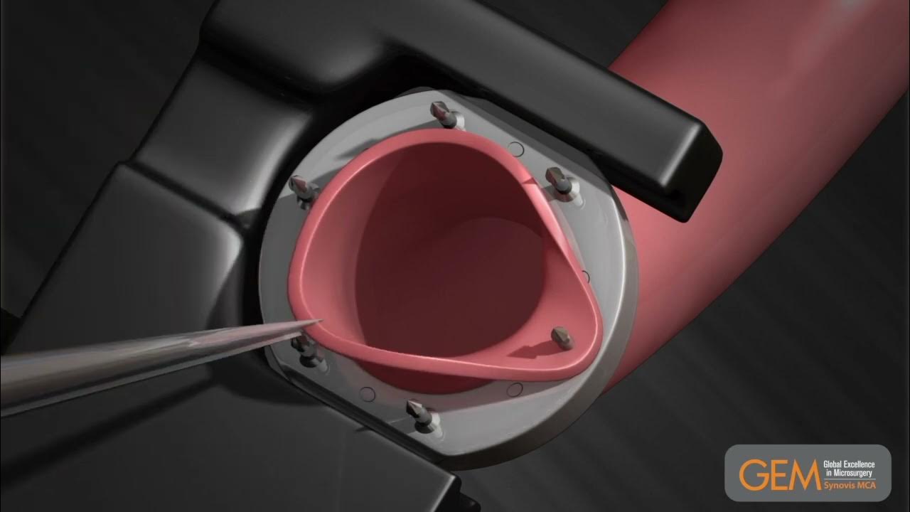 Microvascular Anastomotic GEM COUPLER Device Instructions For Use YouTube microvascular-anastomotic-gem-coupler-device-instructions-for-use-youtube