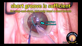 a short groove is sufficient for divide-and-conquer and stop-and-chop cataract surgery