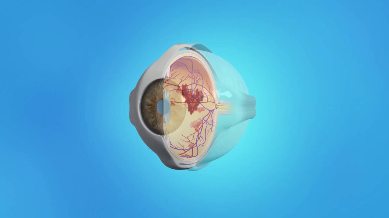 Diabetic Eye Disease (PDR) Vitrectomy - YouTube