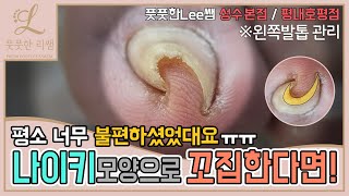 (ENG SUB)나이키 모양으로 꼬집고있는 발톱 때문에 평소 너무 불편하셨대요 😭 ingrown toenail - Fresh Foot 풋풋한리쌤 성수점 / 평내호평점