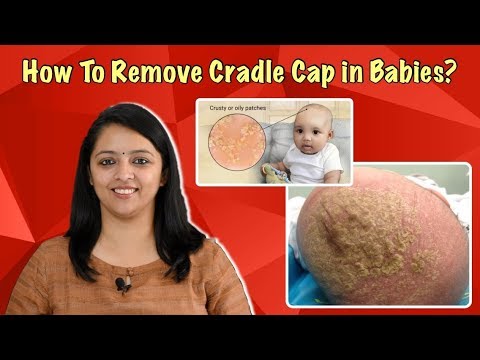 How To Get Rid Of Cradle Cap On A Baby