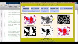 Matlab Project for Leukemia Detection from Blood Cells using neural network