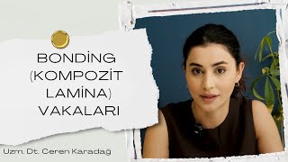 Kompozit Bonding Ile Gülüş Estetiği Öncesi Sonrası Karşılaştırma