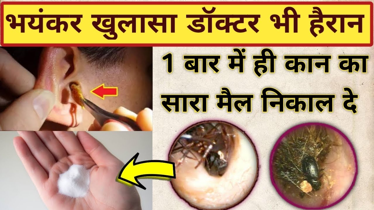 कान में बस 22 बूँद Kan Ka Mail Nikalne Ka Tarika Kaan Saaf Karne Ka Tarika Kaan Ka Mail