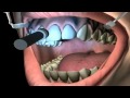 What is Teeth Bleaching?