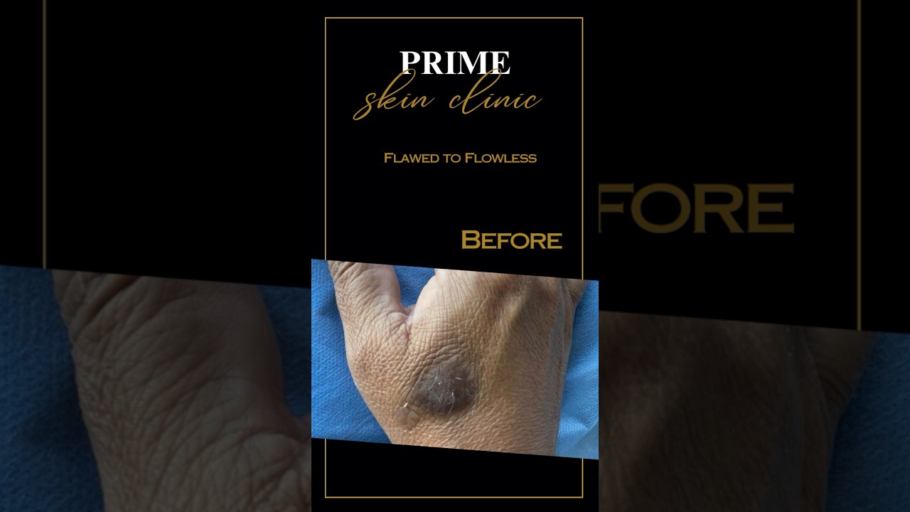 INCREDIBLE SCAR TRANSFORMATION: From Scar to Scarless | Prime Skin Clinic  