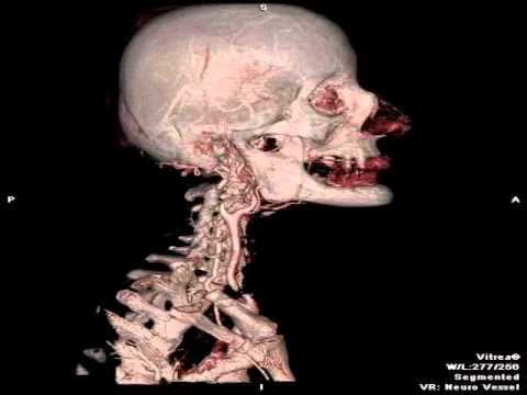კისრის სისხლძარღვების CT ანგიოგრაფია
