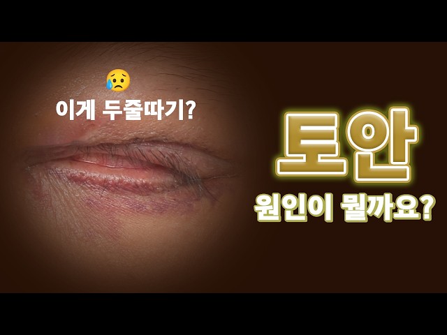 두줄따기는 눈 감기는거 아니었어요?? │토안이 생기는 진짜 이유