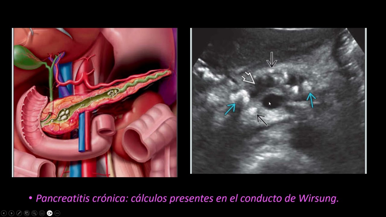 Ecografia del pancreas B