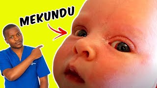 Je Macho Mekundu Kwa Kichanga Husababishwa NA Nini? | Vihatarishi NA Matibabu Yake?