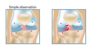 Chondral lesions can hinder recovery from partial meniscectomy