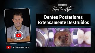 Momento Clínico - Dentes posteriores extensamente destruídos