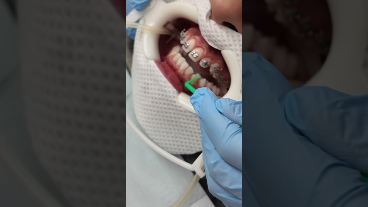 Diamond Braces Orthodontists: Braces & Invisalign Made Simple 