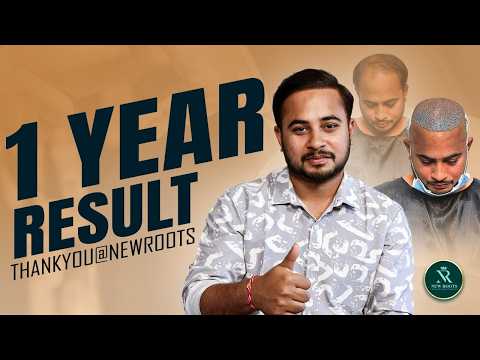 Grade 5 Baldness to Full Hair 😃 | Hair Transplant in Hyderabad (Best Results) | New Roots
