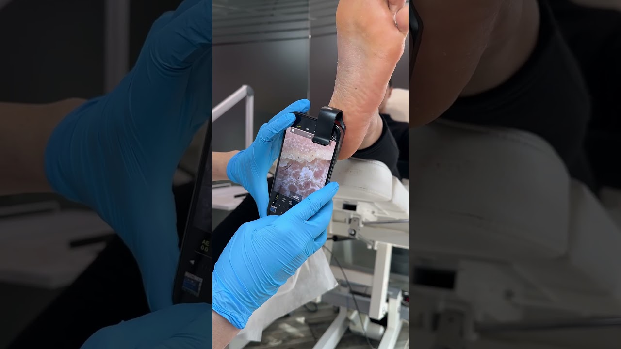 Как выглядит подошвенная бородавка в дерматоскоп