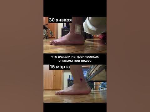Восстановление перелом суставов локтевого плечевого. Травматические повреждения и заболевания локтевого сустава Устройство, используемое для восстановления вращения плечевого и. Минимально инвазивная хирургия локтевого сустава Артроскопическая.