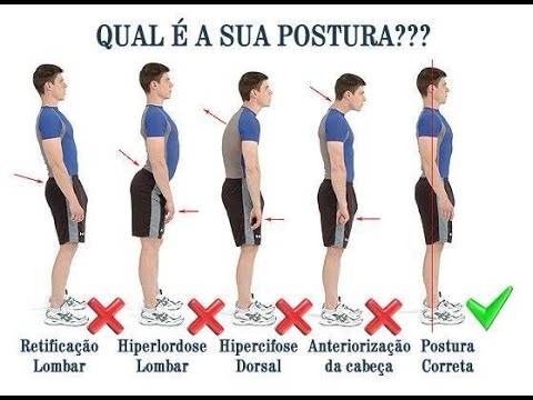 Vídeo: Cifose Lombar - Sintomas E Tratamento