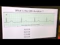 Telemetry Analysis: Video 2: Measuring the Duration of the QRS Complex