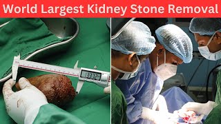 Largest kidney stone removal surgery | Guinness World Record | Sri Lanka