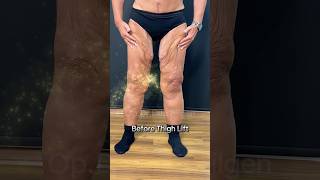 Thigh Lift Surgery Before&amp;After