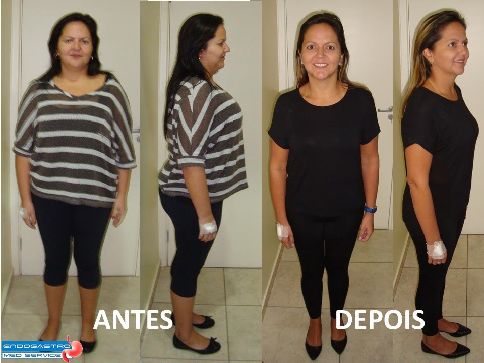 Bianca eliminou 23 Kg com Balão Intragástrico EndogastroRio YouTube