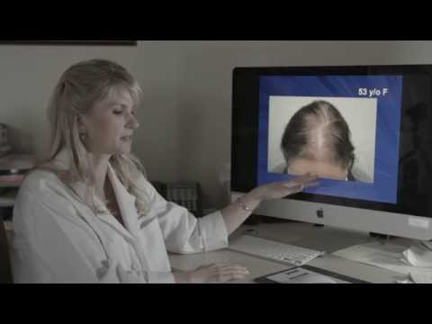 about-male-&-female-pattern-thinning-hair-&-examples-by-dr.-rogers