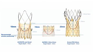 Full TAVI: from first valve to lifetime management - Webinar Guide